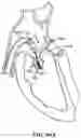 Fig. 111 - CARDIAC VALVE REPAIR DEVICES AND ASSOCIATED SYSTEMS AND METHODS
