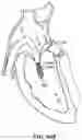 Fig. 112 - CARDIAC VALVE REPAIR DEVICES AND ASSOCIATED SYSTEMS AND METHODS