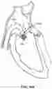 Fig. 113 - CARDIAC VALVE REPAIR DEVICES AND ASSOCIATED SYSTEMS AND METHODS