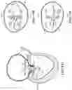Fig. 19 - CARDIAC VALVE REPAIR DEVICES AND ASSOCIATED SYSTEMS AND METHODS