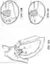 Fig. 23 - CARDIAC VALVE REPAIR DEVICES AND ASSOCIATED SYSTEMS AND METHODS