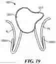 Fig. 24 - CARDIAC VALVE REPAIR DEVICES AND ASSOCIATED SYSTEMS AND METHODS