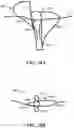 Fig. 41 - CARDIAC VALVE REPAIR DEVICES AND ASSOCIATED SYSTEMS AND METHODS