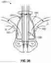 Fig. 44 - CARDIAC VALVE REPAIR DEVICES AND ASSOCIATED SYSTEMS AND METHODS