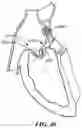 Fig. 62 - CARDIAC VALVE REPAIR DEVICES AND ASSOCIATED SYSTEMS AND METHODS