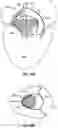 Fig. 74 - CARDIAC VALVE REPAIR DEVICES AND ASSOCIATED SYSTEMS AND METHODS