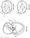 Fig. 91 - CARDIAC VALVE REPAIR DEVICES AND ASSOCIATED SYSTEMS AND METHODS