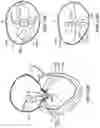 Fig. 94 - CARDIAC VALVE REPAIR DEVICES AND ASSOCIATED SYSTEMS AND METHODS