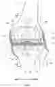 Fig. 03 - Artificial knee joint
