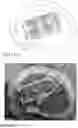Fig. 18 - DISTRIBUTING GRAFT MATERIAL FROM AN EXPANDABLE CAGE