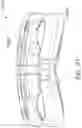 Fig. 82 - Cervical plate and inserter