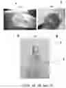 Fig. 04 - SUPER ELASTIC, BIOABSORBABLE ENDOVASCULAR DEVICES