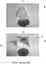 Fig. 05 - SUPER ELASTIC, BIOABSORBABLE ENDOVASCULAR DEVICES