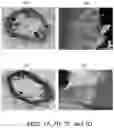 Fig. 08 - SUPER ELASTIC, BIOABSORBABLE ENDOVASCULAR DEVICES