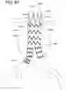 Fig. 56 - AORTIC PROSTHESIS DELIVERY SYSTEM AND METHOD OF USE