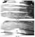 Fig. 15 - Absorbent articles and methods of making