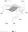 Fig. 09 - Z-shape sliding board utilizing gravity-assistance for patient lateral transfer