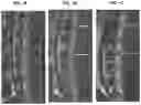 Fig. 02 - Treatment Of Intervertebral Disc Degeneration
