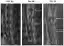 Fig. 04 - Treatment Of Intervertebral Disc Degeneration