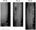 Fig. 05 - Treatment Of Intervertebral Disc Degeneration