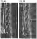 Fig. 06 - Treatment Of Intervertebral Disc Degeneration