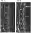 Fig. 08 - Treatment Of Intervertebral Disc Degeneration