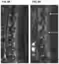 Fig. 10 - Treatment Of Intervertebral Disc Degeneration