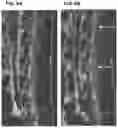 Fig. 12 - Treatment Of Intervertebral Disc Degeneration