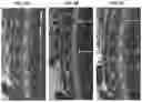 Fig. 14 - Treatment Of Intervertebral Disc Degeneration