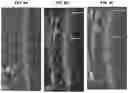 Fig. 16 - Treatment Of Intervertebral Disc Degeneration