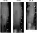 Fig. 17 - Treatment Of Intervertebral Disc Degeneration