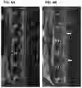 Fig. 18 - Treatment Of Intervertebral Disc Degeneration
