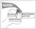 Fig. 01 - COMPOSITIONS AND METHODS FOR TREATING ROTATOR CUFF INJURIES