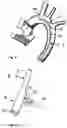 Fig. 06 - Arterial cannula