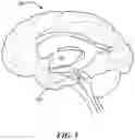 Fig. 06 - Methods of Amelioration of Cerebrospinal Fluid and Devices and Systems Therefor