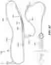 Fig. 12 - Methods of Amelioration of Cerebrospinal Fluid and Devices and Systems Therefor