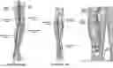 Fig. 01 - PERIPHERAL ARTERY BALLOON, A HYPO-TUBE FOR PREPARING A PERIPHERAL ARTERY BALLOON AND METHODS OF USE THEREOF
