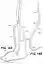 Fig. 19 - PERIPHERAL ARTERY BALLOON, A HYPO-TUBE FOR PREPARING A PERIPHERAL ARTERY BALLOON AND METHODS OF USE THEREOF