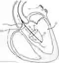 Fig. 01 - HEART ASSIST DEVICE