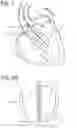 Fig. 02 - HEART ASSIST DEVICE