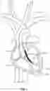 Fig. 02 - MECHANICAL CIRCULATORY SUPPORT SYSTEM WITH GUIDEWIRE AID