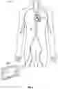 Fig. 03 - MECHANICAL CIRCULATORY SUPPORT SYSTEM WITH GUIDEWIRE AID