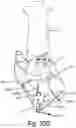 Fig. 53 - Electrode contact for a subcutaneous device
