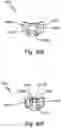 Fig. 86 - Electrode contact for a subcutaneous device