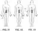 Fig. 14 - METHODS AND SYSTEMS FOR IMPLANTING A NEUROMODULATION SYSTEM AT A SURGICALLY OPEN SPINAL TREATMENT SITE