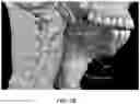 Fig. 04 - Implantable electrodes with remote power delivery for treating sleep apnea, and associated systems and methods
