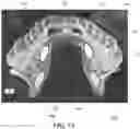 Fig. 08 - Implantable electrodes with remote power delivery for treating sleep apnea, and associated systems and methods