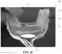 Fig. 10 - Implantable electrodes with remote power delivery for treating sleep apnea, and associated systems and methods