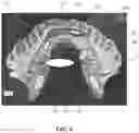 Fig. 11 - Implantable electrodes with remote power delivery for treating sleep apnea, and associated systems and methods