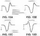 Fig. 21 - Efficient delivery of multi-site pacing